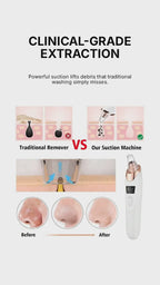 PoreVac Pro™ – Limpiador Facial de Succión Profesional