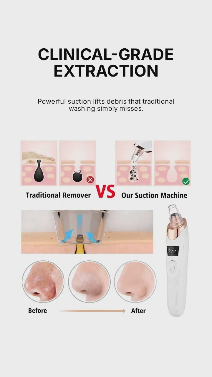 PoreVac Pro™ – Limpiador Facial de Succión Profesional