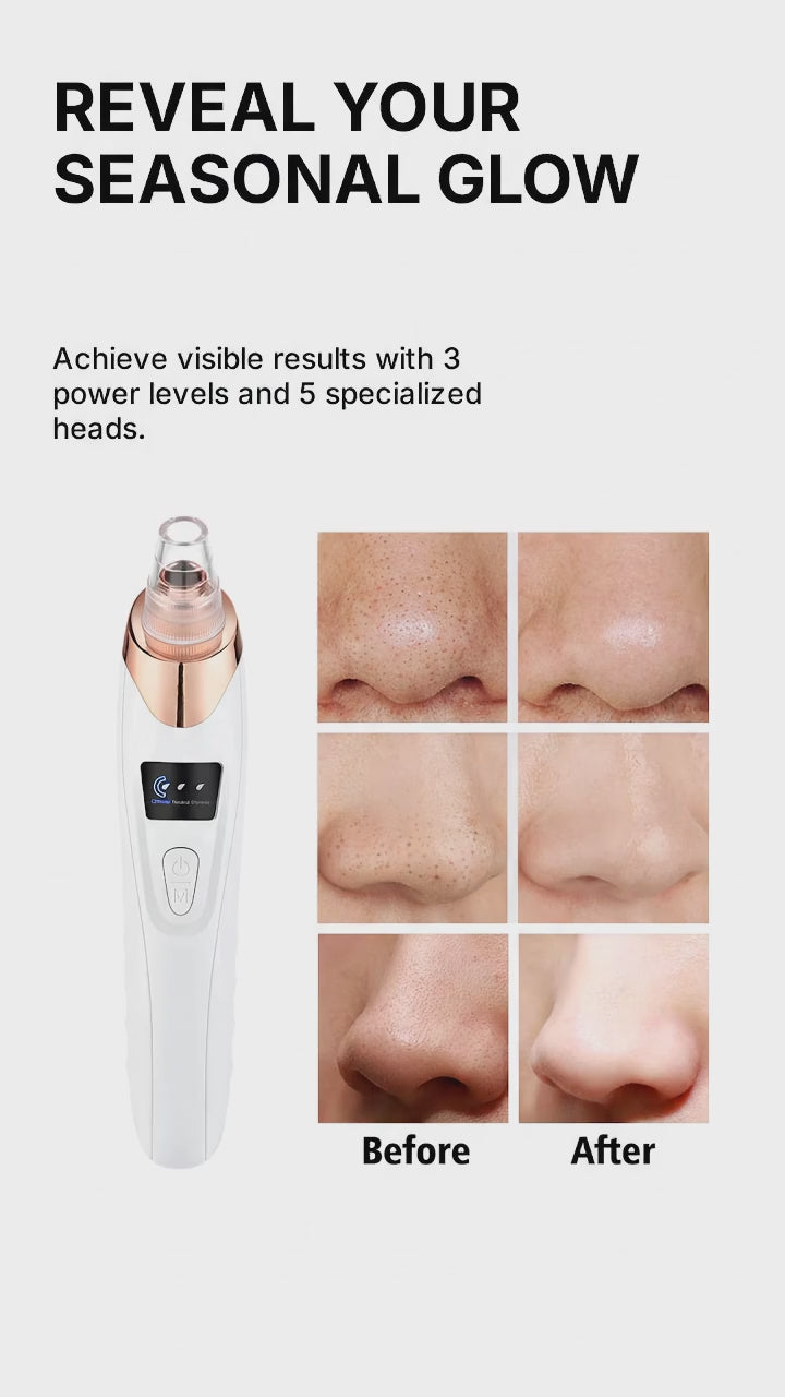 PoreVac Pro™ – Limpiador Facial de Succión Profesional