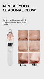 PoreVac Pro™ – Limpiador Facial de Succión Profesional